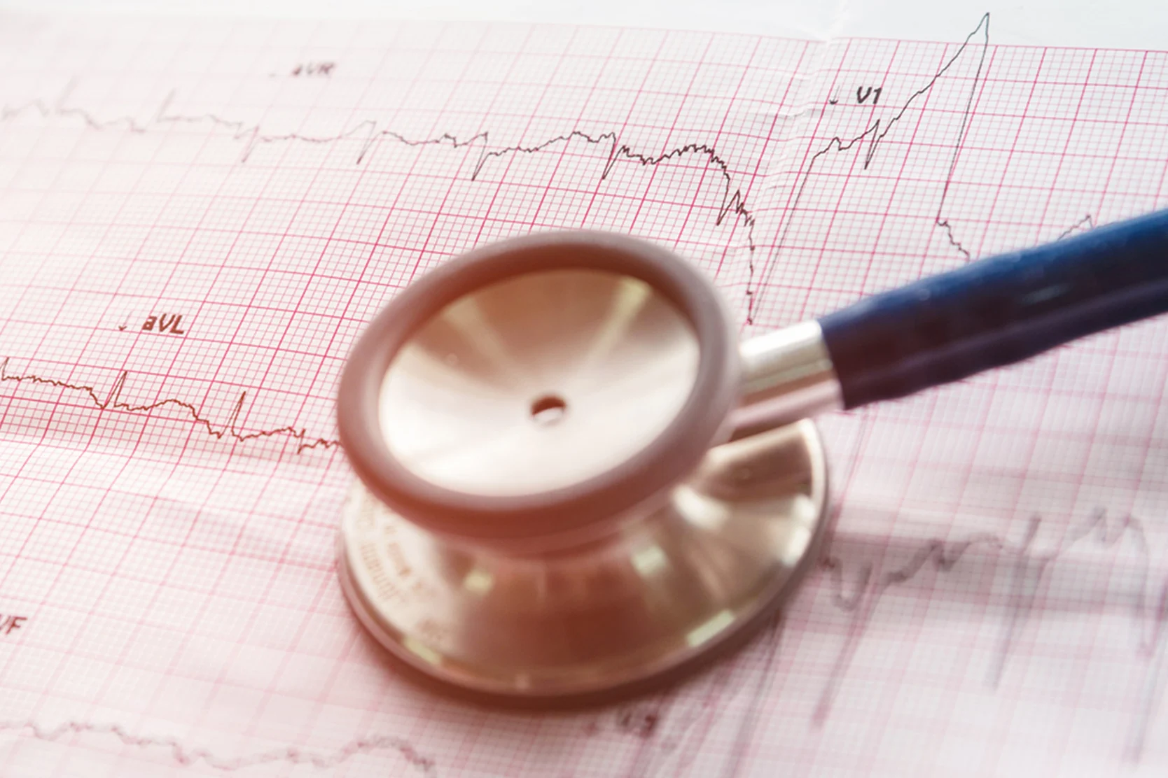electrophysiology-study-and-catheter-ablation-2x