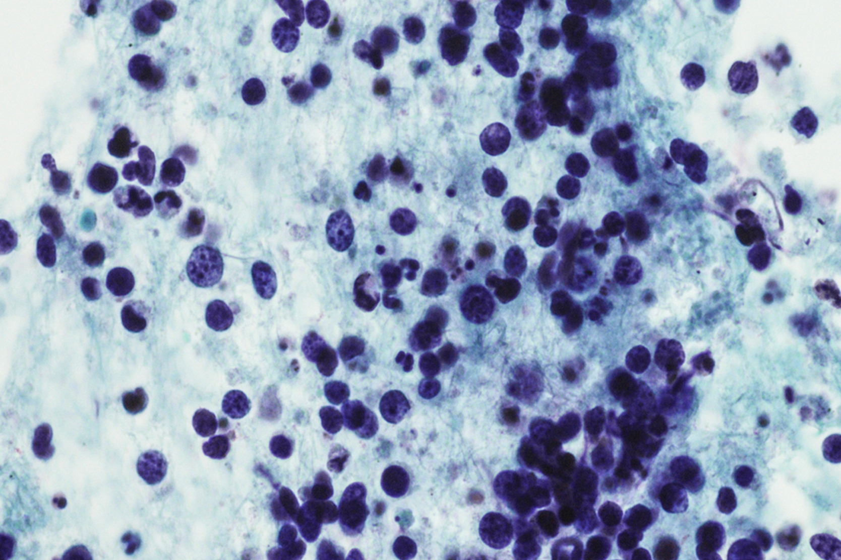 intensity-modulated-radiation-therapy-imrt-2x