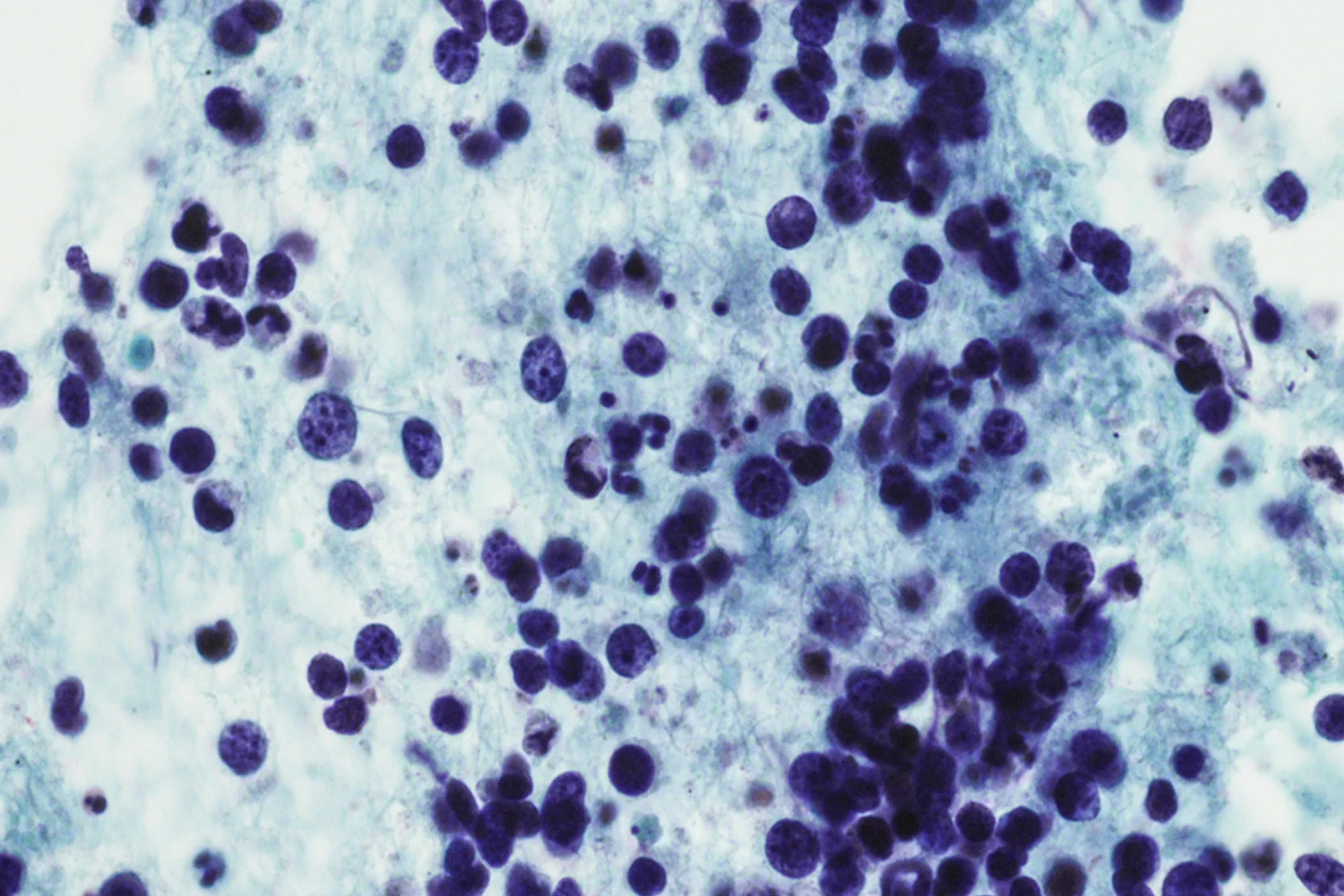 intensity-modulated-radiation-therapy-imrt-2x