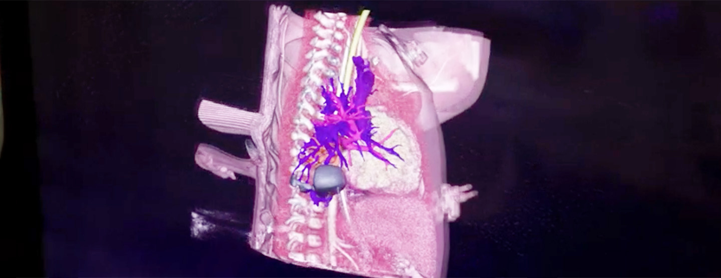 Designing better heart procedures