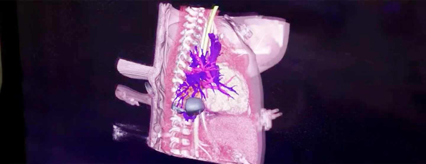 Designing better heart procedures