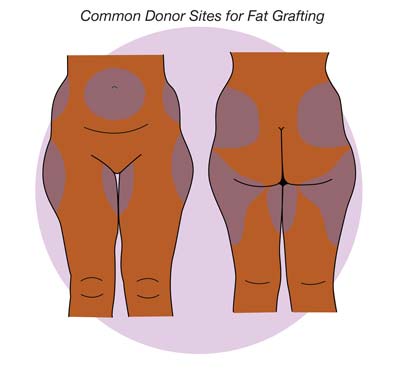 Common Donor Sites for Fat Grafting