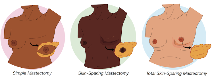 Total skin-sparing mastectomy illustration