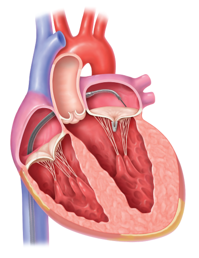 Procedure illustration