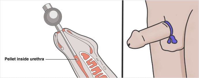 Pellet inside uretra illustration