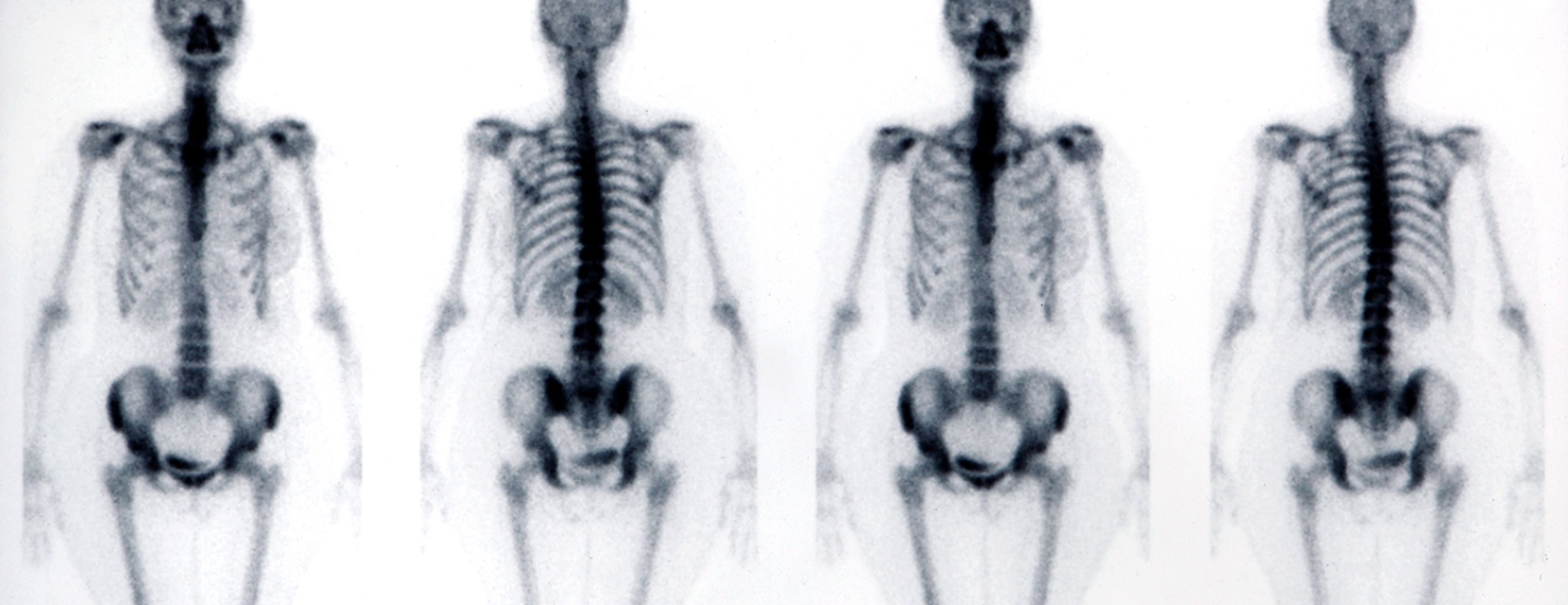 Bone scan | UCSF Health