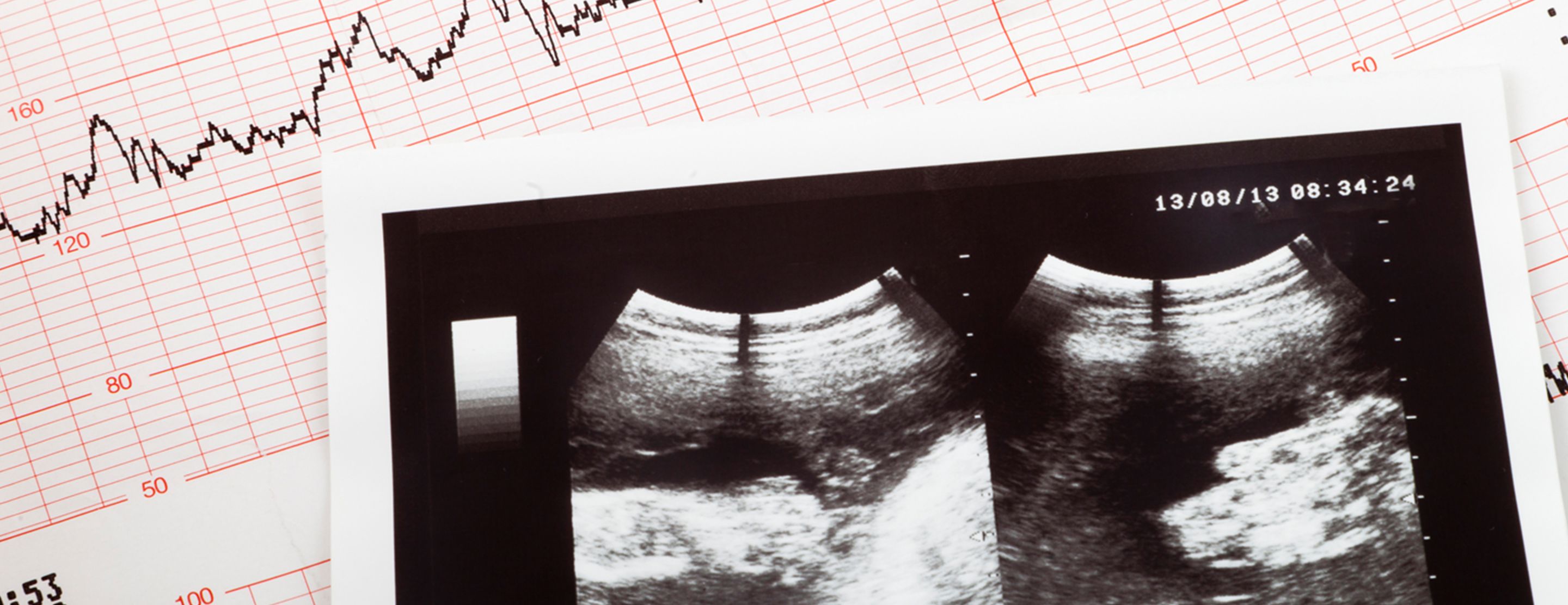 Fetal echocardiography | UCSF Health