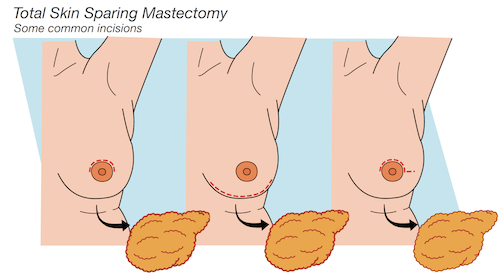Total skin-sparing mastectomy: Some common incisions