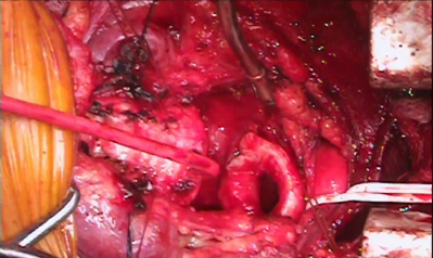 Resection of tracheal rings in airway