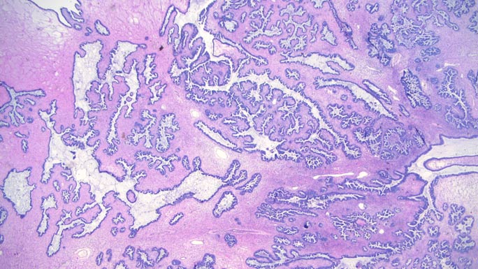 A microscopic example of a serous borderline tumor showing a hierarchical “branching” pattern not seen in completely benign cysts or normal tissue