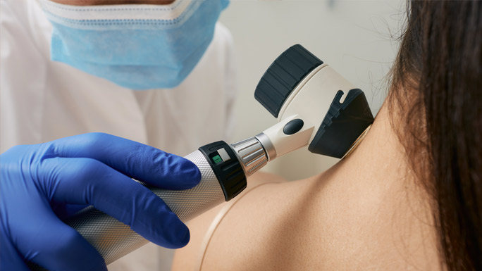 physician using dermatoscope to examine a mole