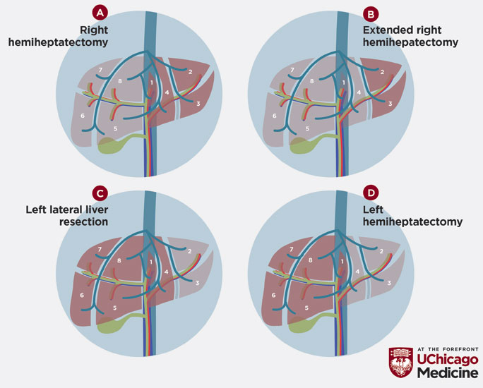 illustration of types of hepatobiliary tumor surgery