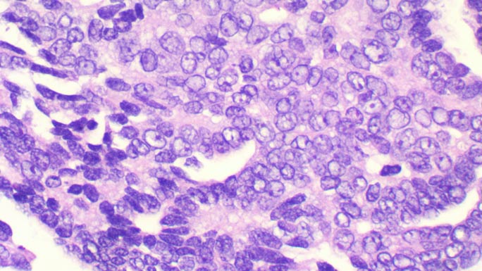 microscopic example of low-grade serous epithelial ovarian cancer