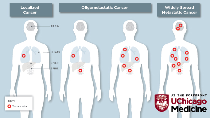 oligometastatic cancer, limited metastatic cancer