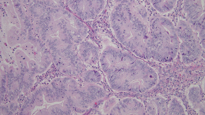 A microscopic example of a mucinous tumor showing malignant glands with mucin replacing the normal ovary.