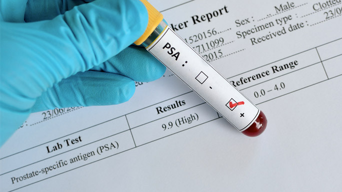 vial of blood and PSA test report results