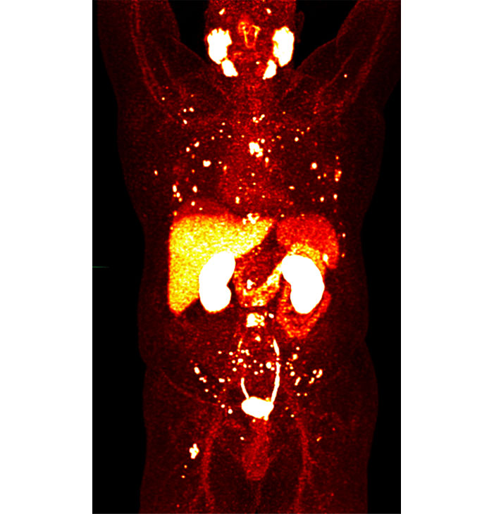 PSMA PET scan showing "hot dots" of prostate cancer