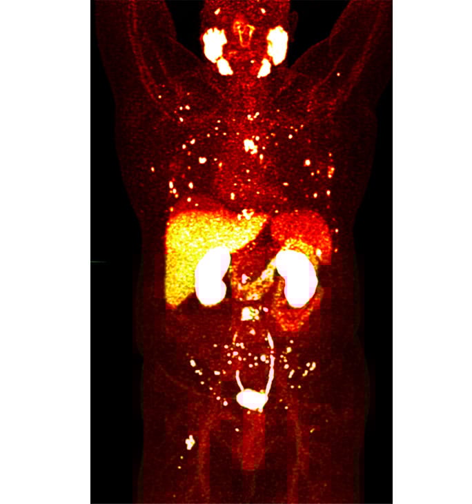 PSMA PET scan showing "hot dots" of prostate cancer