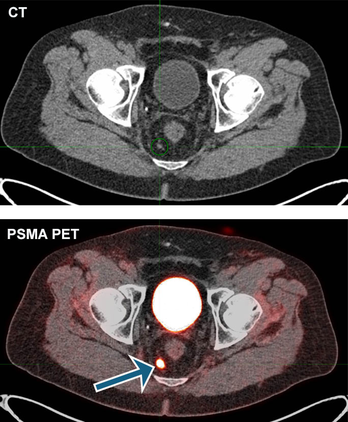 A follow-up CT scan for a patient treated for prostate cancer showed a normal-appearing, 2 mm lymph node (top image). But a PMSA PET scan spotted prostate cancer cells in the tiny node (see arrow in bottom image). 