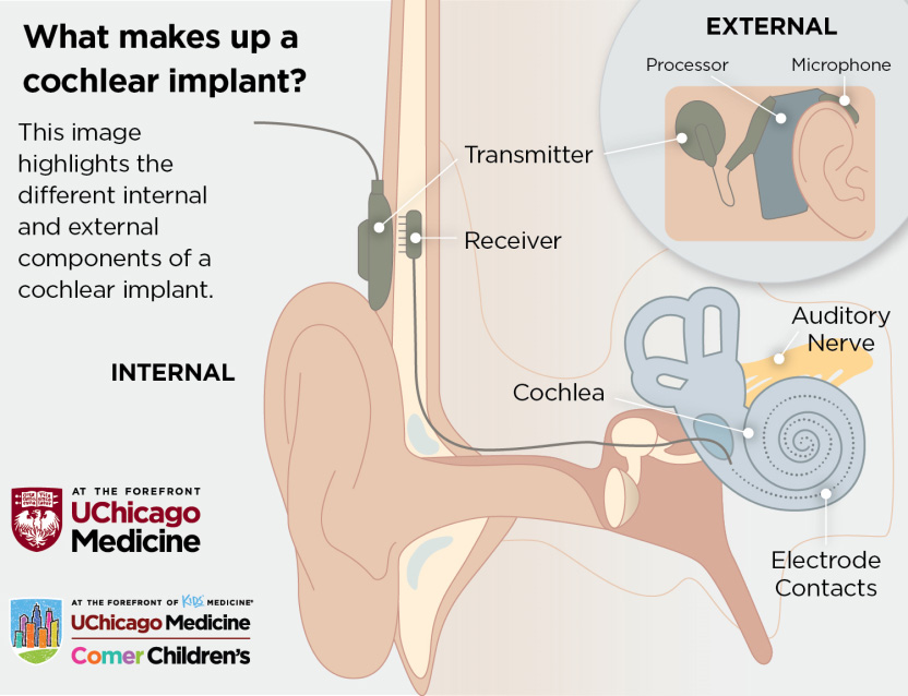 Illustration of how a cochlear implant works