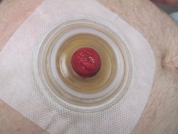A picture of how an ostomy bag skin barrier should look when it is fit properly around a stoma