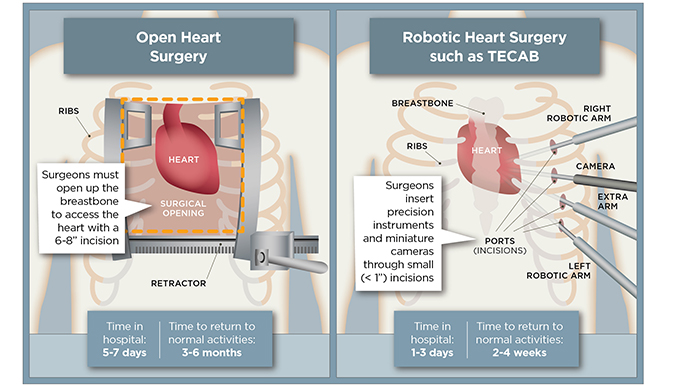 Robotic TECAB versus open surgery