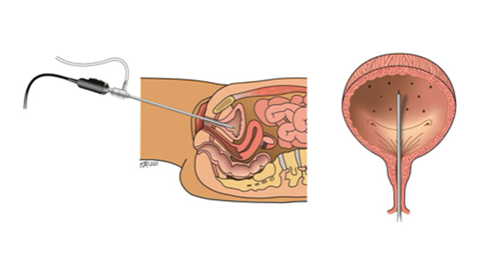 Illustration of Botox procedure for urinary incontinence
