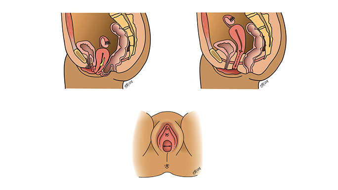 Illustrations of colpocleisis procedure