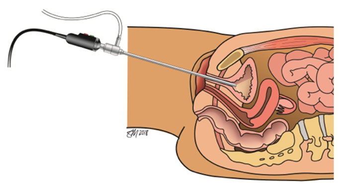 Illustration of cysto-urethroscopy