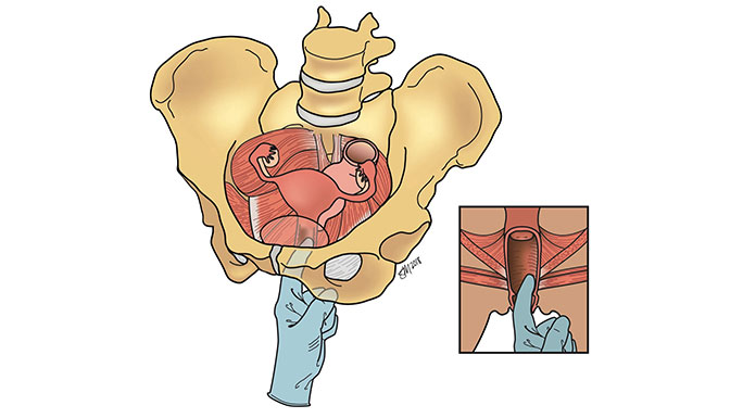 Illustration of pelvic floor physical therapy