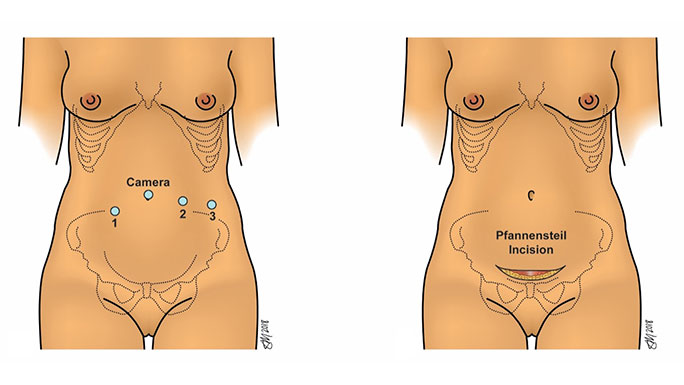Illustration of incisions for pelvic organ prolapse surgery