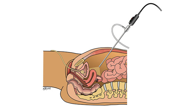 Illustration of pelvic organ prolapse surgery
