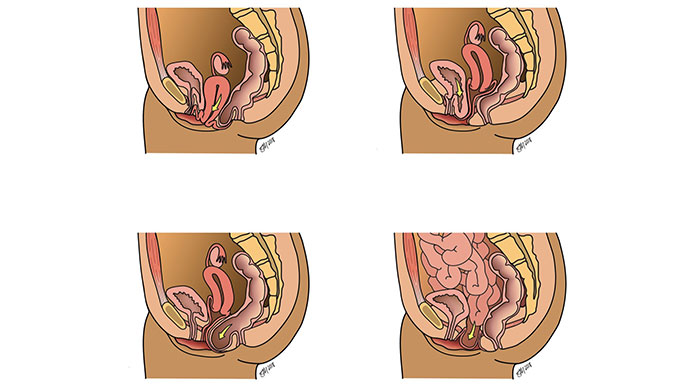 Illustration of types of pelvic organ prolapse
