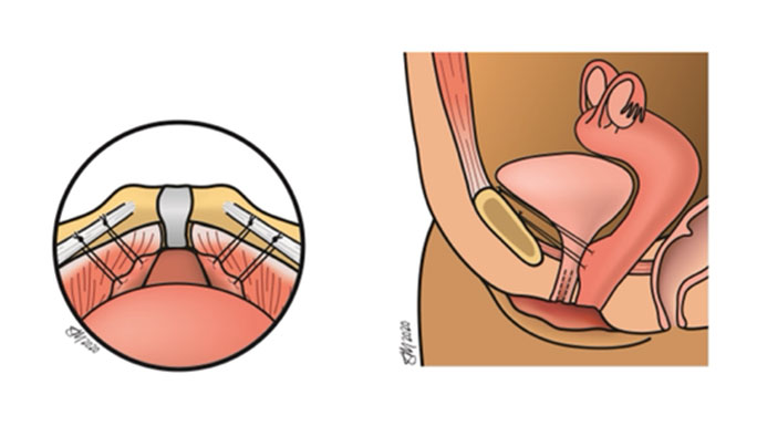 Illustration of retropubic colposuspension procedures