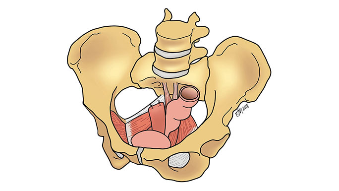 Illustration of sacrospinous ligament suspension