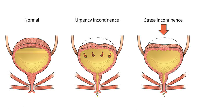 Types of urinary incontinence