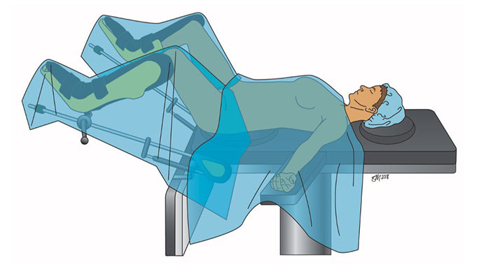 Illustration of patient positioned for urogynecologic surgery