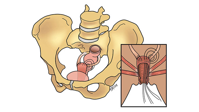Illustration of uterosacral ligament suspension