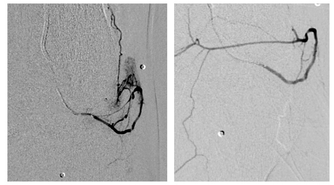 pre and post embolization