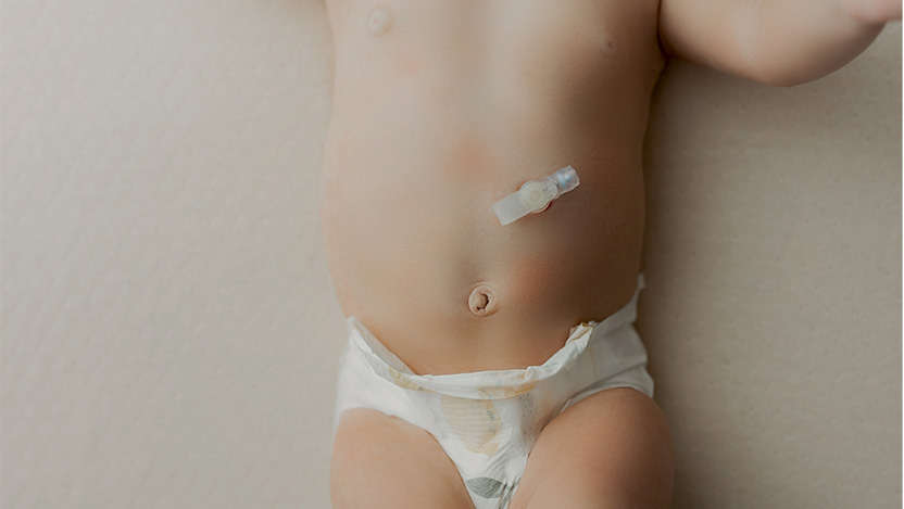 Image of a baby's belly shown with a G-tube