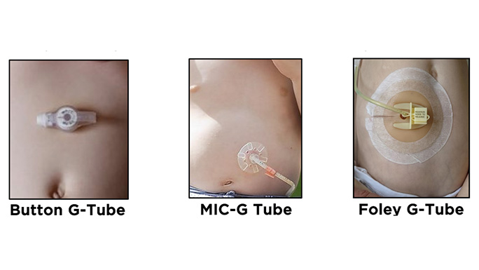 Types of pediatric g tubes