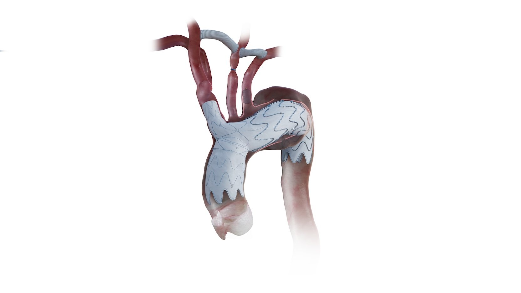 Breakthrough stent for aortic arch disease wins FDA approval, led by UChicago Medicine surgeon