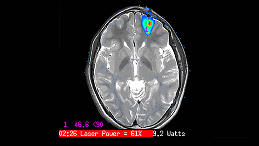 Image of brain scan with seizure source