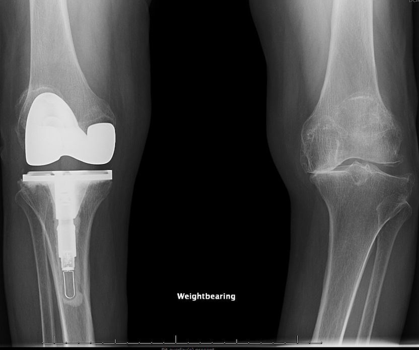 An X-ray shows Luz Graciela Gamero's knees - one with the new smart knee implant, and the other, which is awaiting an implant.