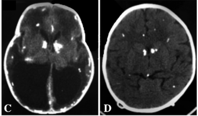 Hydrocephalus brain images