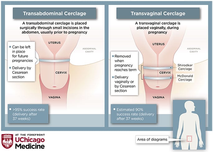 “Diagram comparing transabdominal cerclage and transvaginal cerclage procedures
