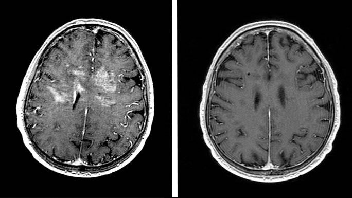 Left: Bright areas on an MRI scan show the tumor on both sides of Leo's brain. Right: MRI after treatment demonstrates a complete response to therapy
