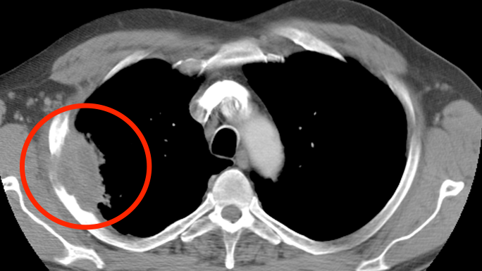 CT scan of Greg Klawitter's lung cancer