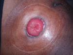 A picture of an end colostomy