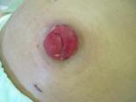A picture of an end ileostomy